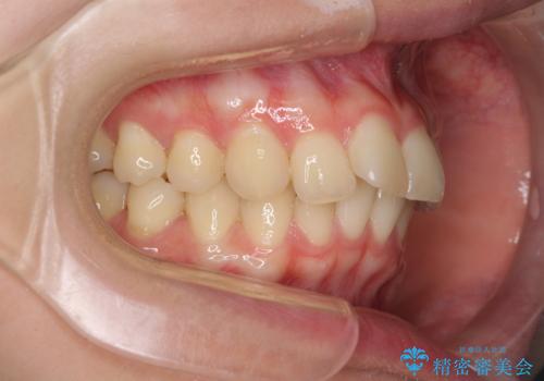 飛び出した前歯と黄ばんだ歯 ホワイトニングしながらマウスピース矯正の治療前