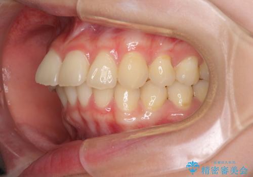 飛び出した前歯と黄ばんだ歯 ホワイトニングしながらマウスピース矯正の治療前