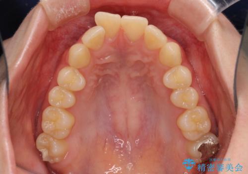飛び出した前歯と黄ばんだ歯 ホワイトニングしながらマウスピース矯正の治療前