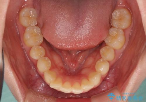飛び出した前歯と黄ばんだ歯 ホワイトニングしながらマウスピース矯正の治療前
