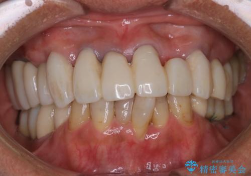 治療中の仮歯もPMTCで白くきれいにの治療前