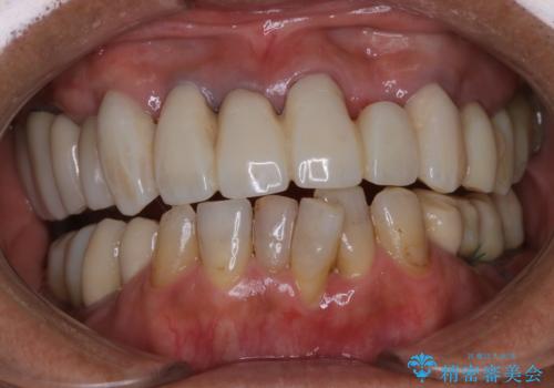 治療中の仮歯もPMTCで白くきれいにの治療前
