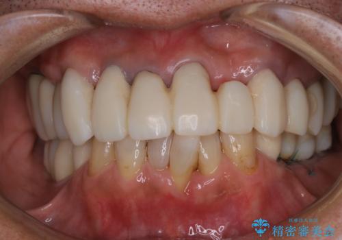 治療中の仮歯もPMTCで白くきれいにの治療後