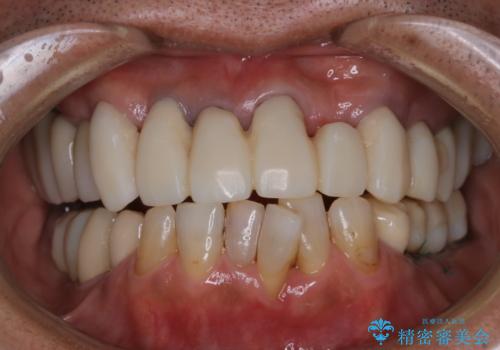 治療中の仮歯もPMTCで白くきれいにの治療後