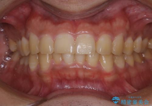 数年ぶりに歯のクリーニング(PMTC)の治療前