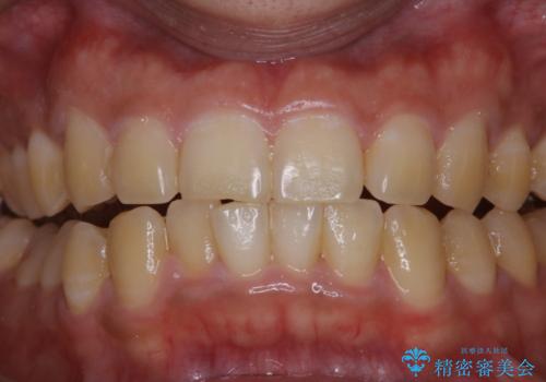数年ぶりに歯のクリーニング(PMTC)の治療前
