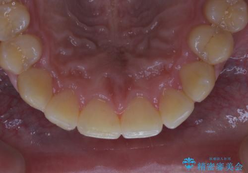数年ぶりに歯のクリーニング(PMTC)の治療前