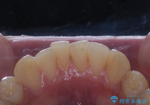 数年ぶりに歯のクリーニング(PMTC)の治療前