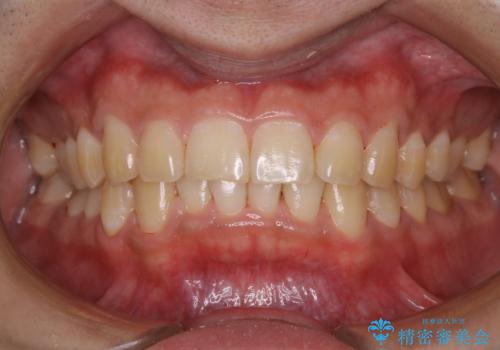 数年ぶりに歯のクリーニング(PMTC)の治療後