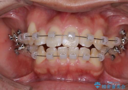 オーディションで歯並びを指摘された:自信をもって歌える口元への治療中