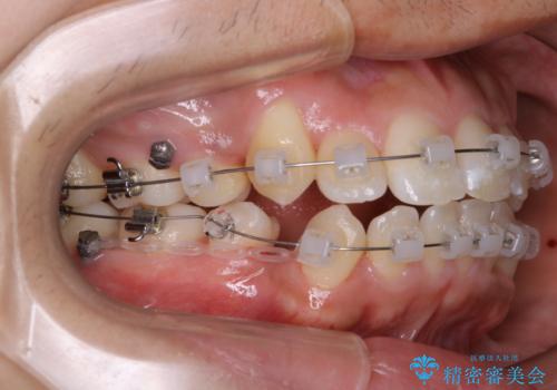 オーディションで歯並びを指摘された:自信をもって歌える口元への治療中