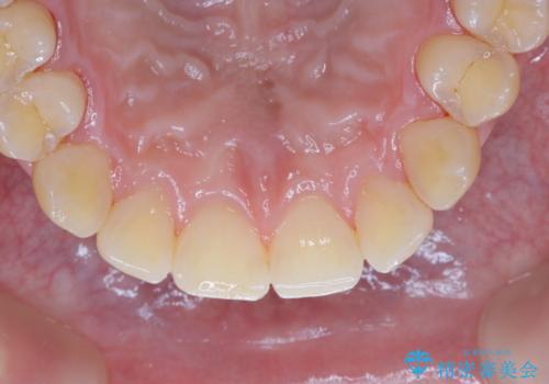 数年ぶりに歯のクリーニング(PMTC)の治療後