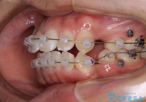 オーディションで歯並びを指摘された:自信をもって歌える口元への治療中