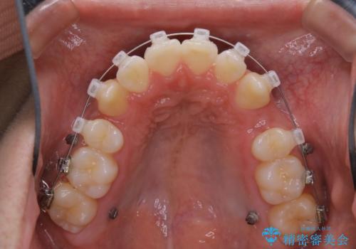オーディションで歯並びを指摘された:自信をもって歌える口元への治療中