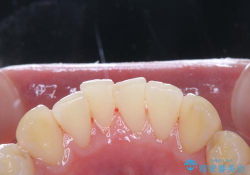 数年ぶりに歯のクリーニング(PMTC)の治療後