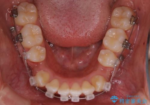 オーディションで歯並びを指摘された:自信をもって歌える口元への治療中