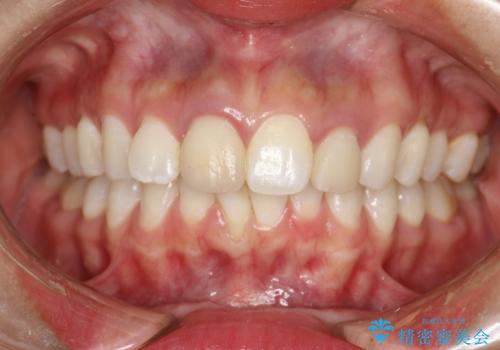 後戻りした歯並びをきれいにしたいの症例 治療前