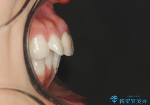 後戻りした歯並びをきれいにしたいの治療前