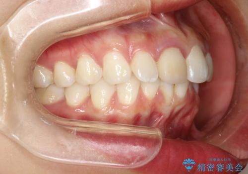 後戻りした歯並びをきれいにしたいの治療前