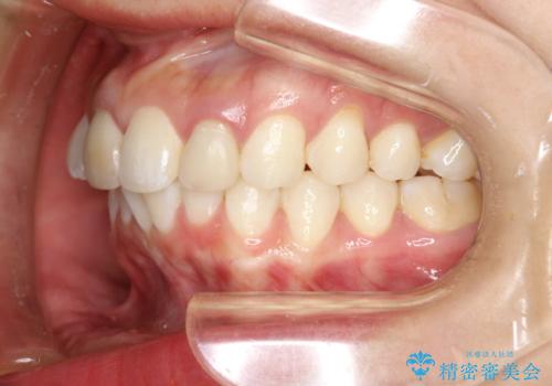 後戻りした歯並びをきれいにしたいの治療前
