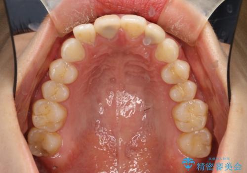 後戻りした歯並びをきれいにしたいの治療前