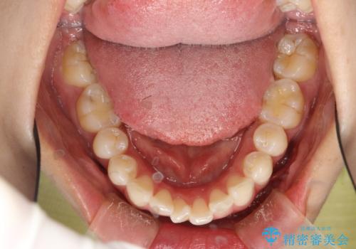 後戻りした歯並びをきれいにしたいの治療前