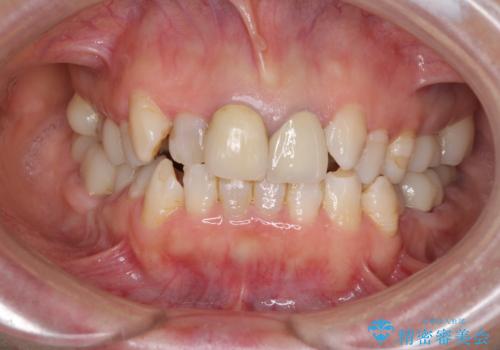 奥歯の銀歯と歯並びを改善　歯周外科治療と矯正治療を行った総合歯科診療の治療中