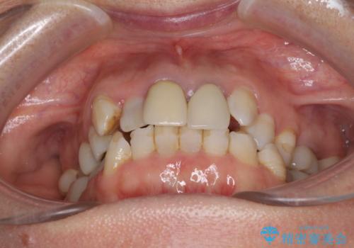 奥歯の銀歯と歯並びを改善　歯周外科治療と矯正治療を行った総合歯科診療の治療中