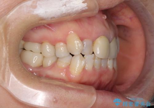 奥歯の銀歯と歯並びを改善　歯周外科治療と矯正治療を行った総合歯科診療の治療中