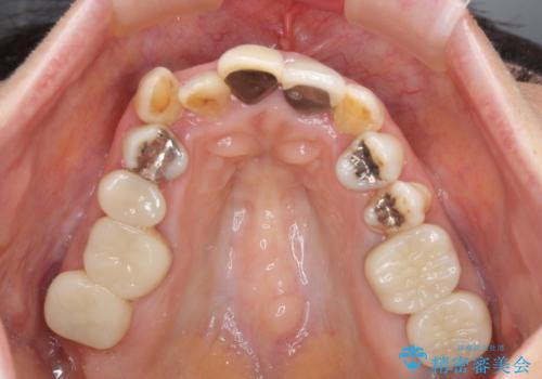 奥歯の銀歯と歯並びを改善　歯周外科治療と矯正治療を行った総合歯科診療の治療中