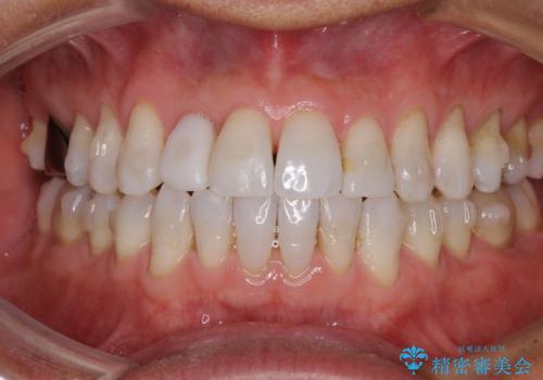 治療途中の前歯を治したい インビザライン矯正とオールセラミッククラウンの治療中