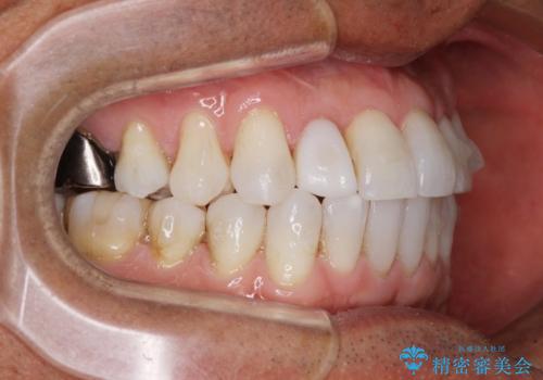 治療途中の前歯を治したい インビザライン矯正とオールセラミッククラウンの治療中
