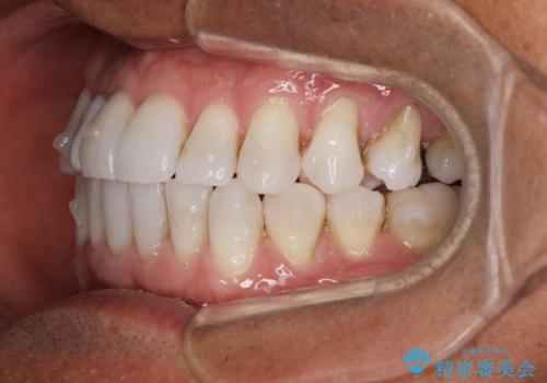 治療途中の前歯を治したい インビザライン矯正とオールセラミッククラウンの治療中