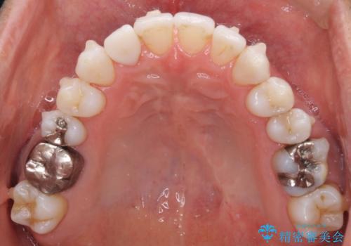 治療途中の前歯を治したい インビザライン矯正とオールセラミッククラウンの治療中