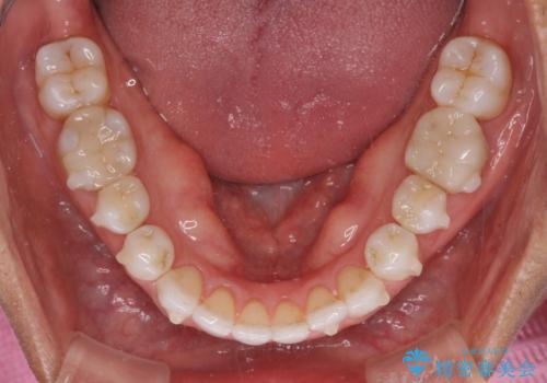 治療途中の前歯を治したい インビザライン矯正とオールセラミッククラウンの治療中