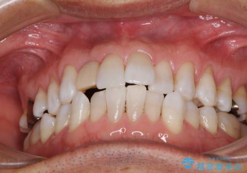 治療途中の前歯を治したい インビザライン矯正とオールセラミッククラウンの治療前