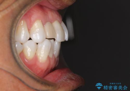 治療途中の前歯を治したい インビザライン矯正とオールセラミッククラウンの治療前