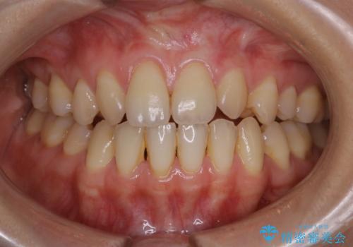 office-whitening(エクセレント)の治療前