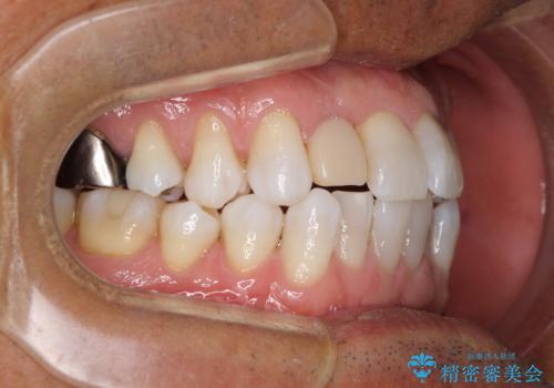 治療途中の前歯を治したい　インビザライン矯正とオールセラミッククラウンの治療前