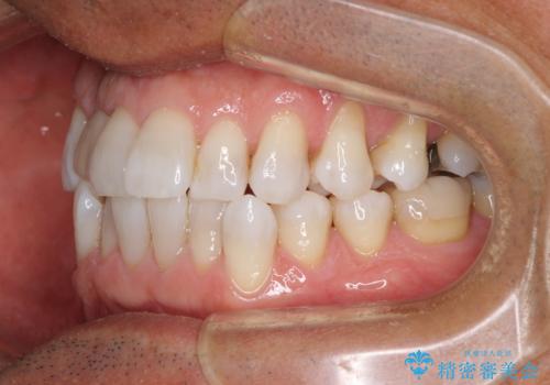 治療途中の前歯を治したい　インビザライン矯正とオールセラミッククラウンの治療前