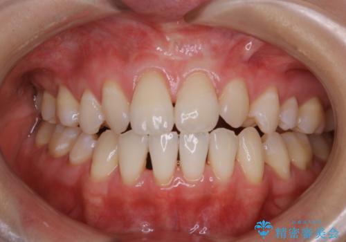 office-whitening(エクセレント)の治療後