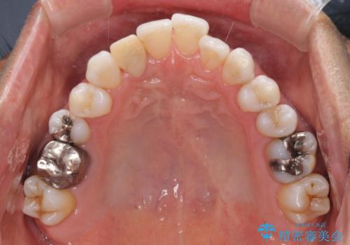 治療途中の前歯を治したい インビザライン矯正とオールセラミッククラウンの治療前