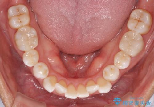 治療途中の前歯を治したい インビザライン矯正とオールセラミッククラウンの治療前