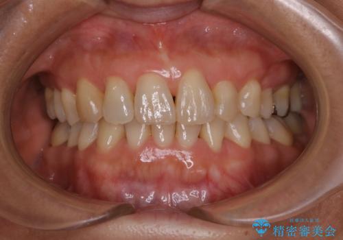 下の前歯が見えない:深い噛み合わせもインビザラインでの症例 治療後