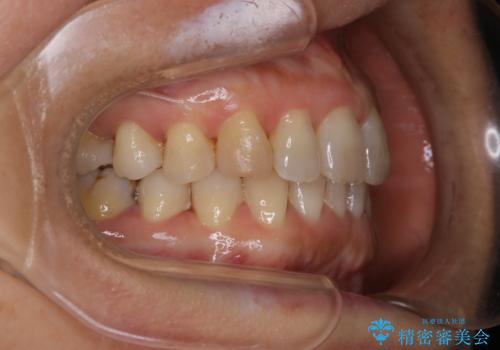 下の前歯が見えない:深い噛み合わせもインビザラインでの治療後