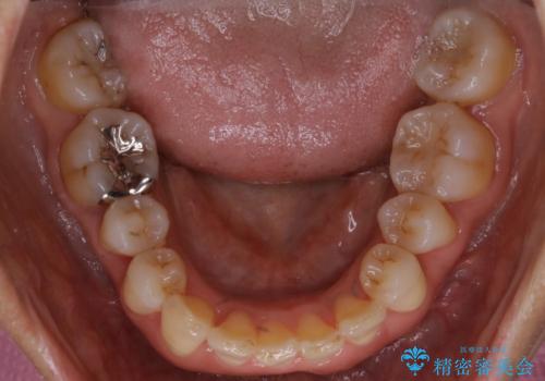 下の前歯が見えない:深い噛み合わせもインビザラインでの治療後