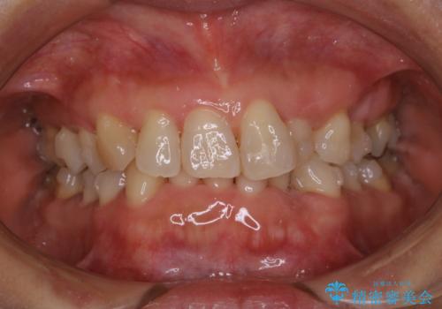 下の前歯が見えない:深い噛み合わせもインビザラインでの治療中