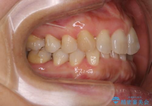 下の前歯が見えない:深い噛み合わせもインビザラインでの治療中