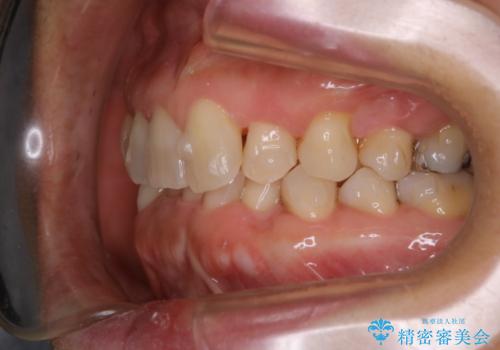 下の前歯が見えない:深い噛み合わせもインビザラインでの治療中