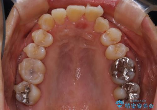 下の前歯が見えない:深い噛み合わせもインビザラインでの治療中